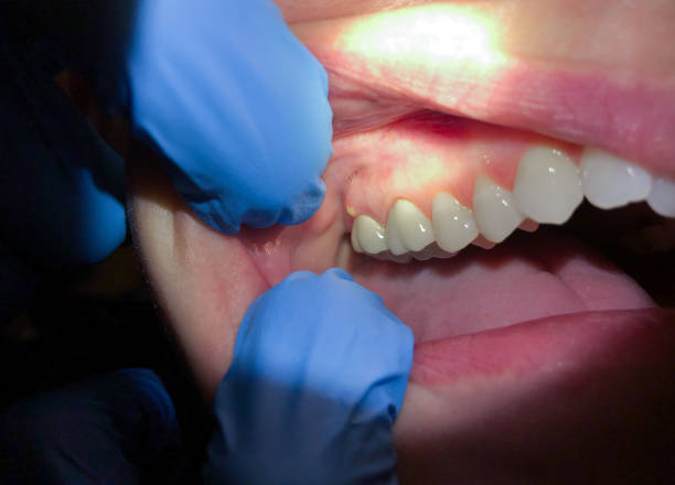 Best Dental Abscess Treatment in Steiner Ranch, TX
